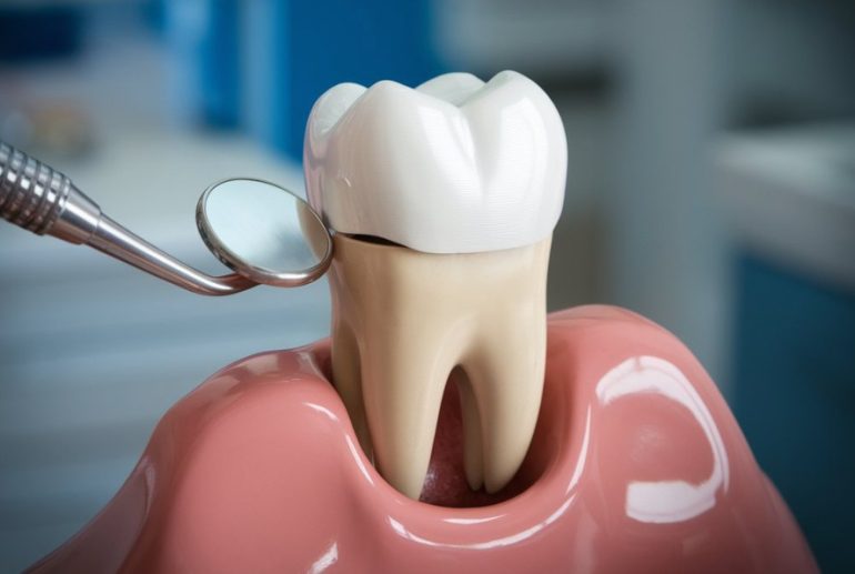 Временные зубные коронки: установка и ограничения