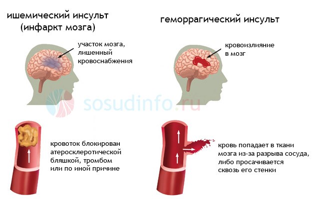 Нарушение мозгового кровообращения: симптомы, признаки, лечение