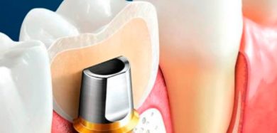 Современные методы установки имплантов зубов: качество жизни и эстетика в одном